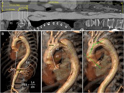 Aortic Geometric Alteration Associated With Acute Type B Aortic Dissection: Angulation, Tortuosity, and Arch Type